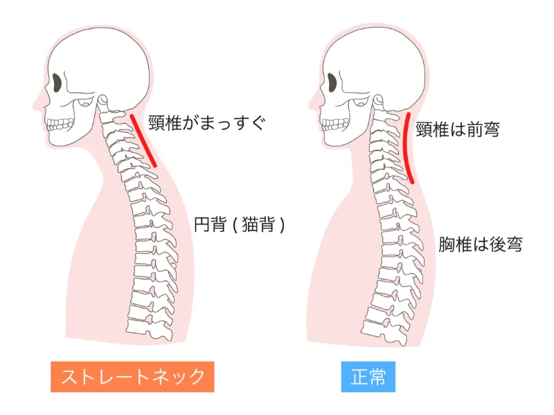 ストレートネック イメージ